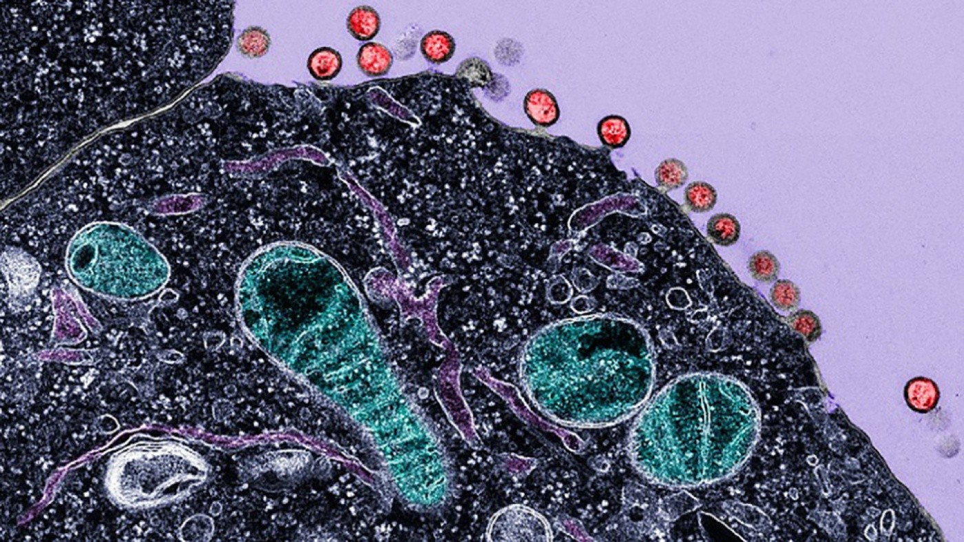 Electron micrograph of cells infected with HIV